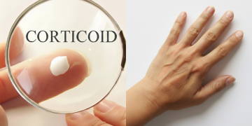 ? Vì sao bôi thuốc corticoid khiến da mỏng và sạm hơn?