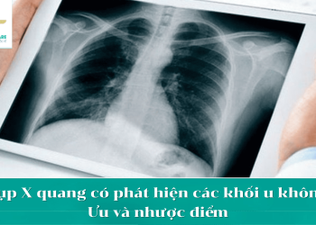 Chup X-Quang là gì?