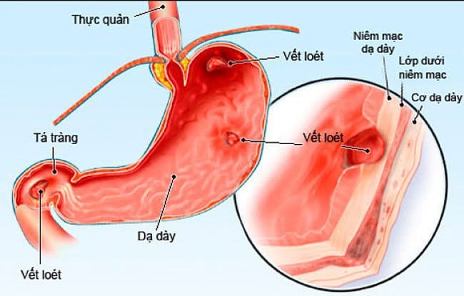 Phát hiện viêm loét và ung thư sớm nhờ nội soi dạ dày