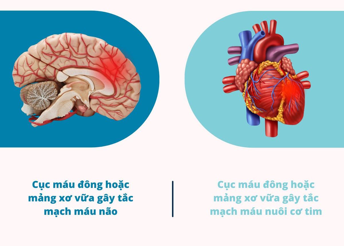 Phân biệt đột quỵ não và đột quỵ tim
