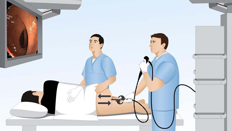 Phân loại nội soi trực tràng
